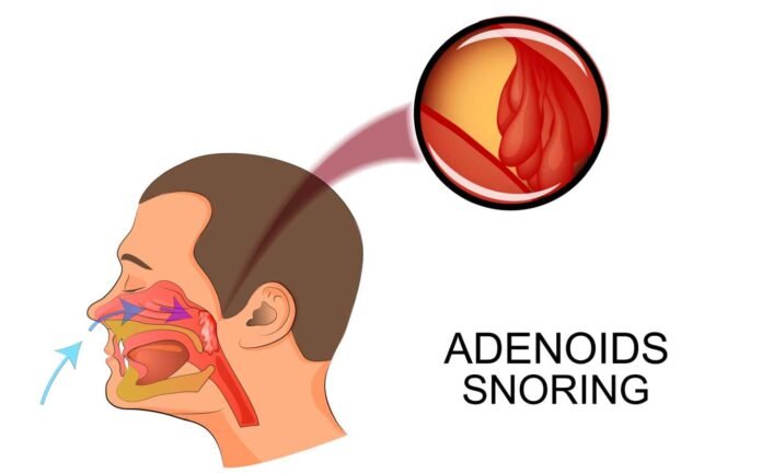 A vector image showing adenoids and how they can cause snoring.