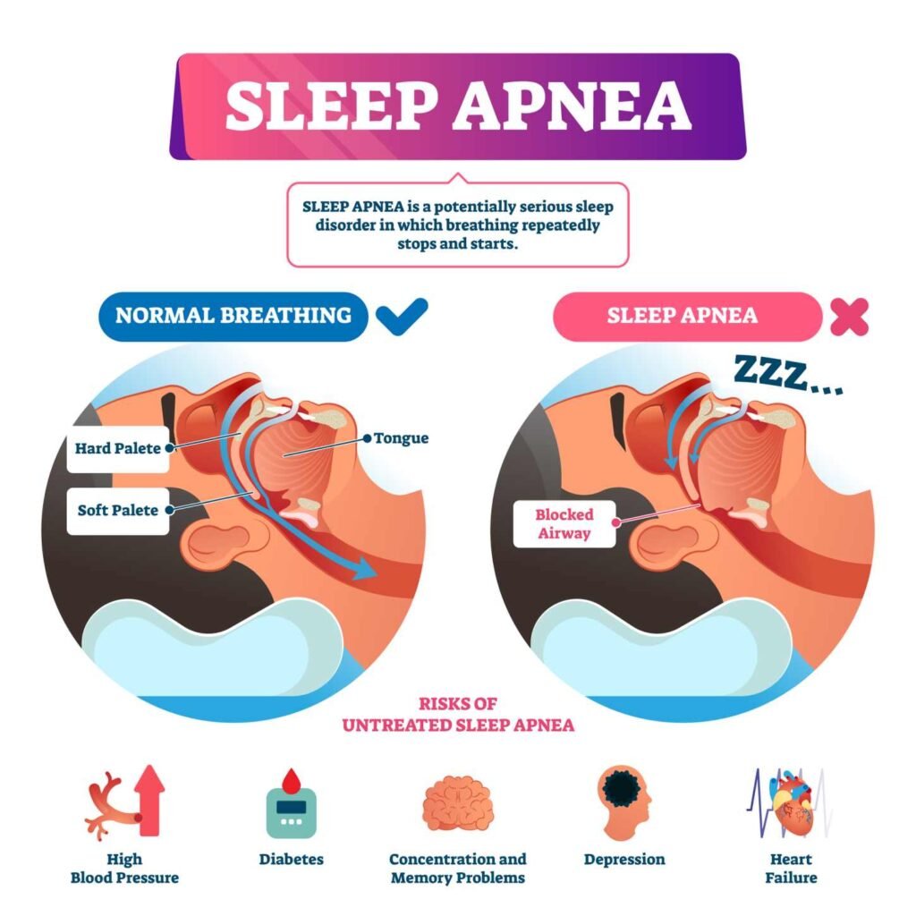 An info graphic about sleep apnea.