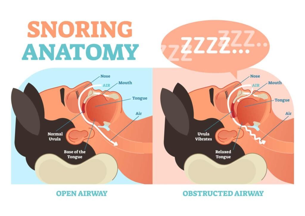 A diagram of snoring anatomy including air passages.