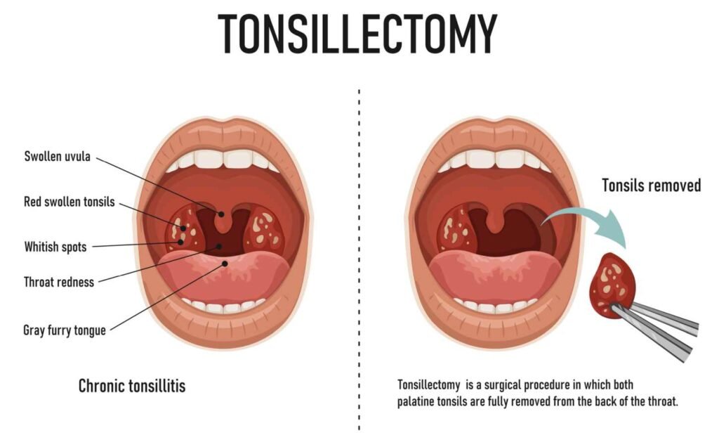 A vector image of the tonsillectomy procedure. Which is ofetn done at the same time as a adenoidectomy.