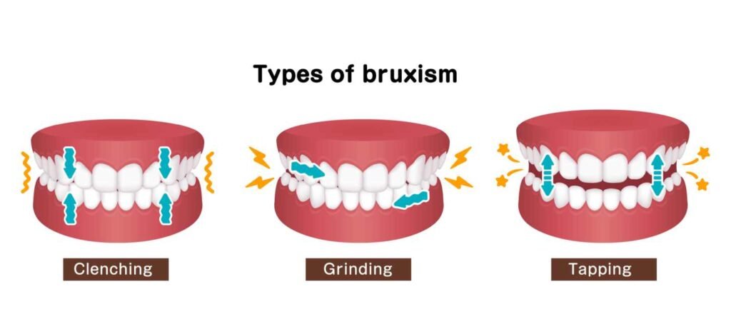 A graphic of three types of Bruxism, clenching, grinding and tapping.